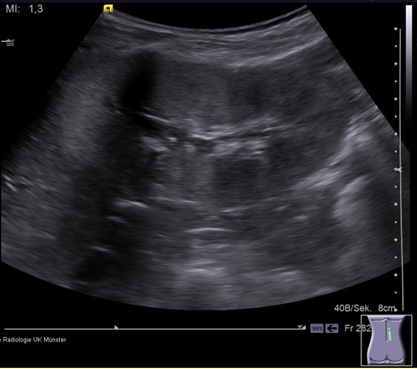 Nephronophthise Neocyst