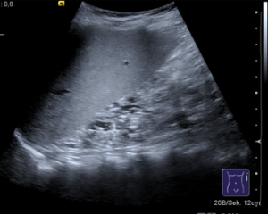 ARPKD in ultrasound