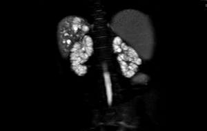 ARPKD in MRI