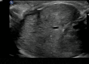 ARPKD intrauterin