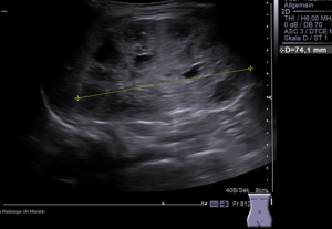 ARPKD in ultrasound