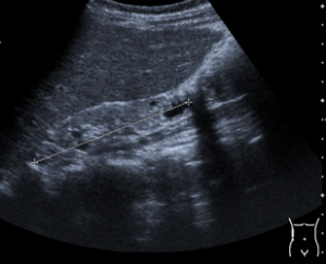 dysplastic kidney in JS