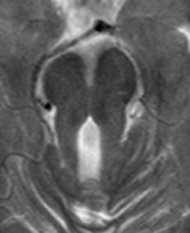molar tooth sign in MRI